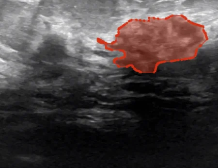 Segmentation of tumor in ultrasound video
