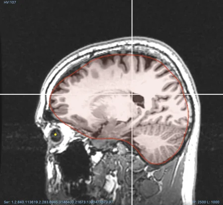 Segmentation of brain in CT scan